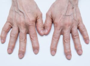 Fingers in Rheumatic Diseases - Fingers, Deformed - Signs and Symptoms -  McMaster Textbook of Internal Medicine